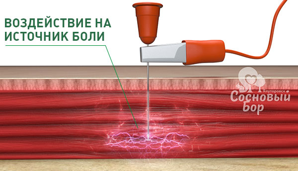 Лечение боли в мышцах и сутавах